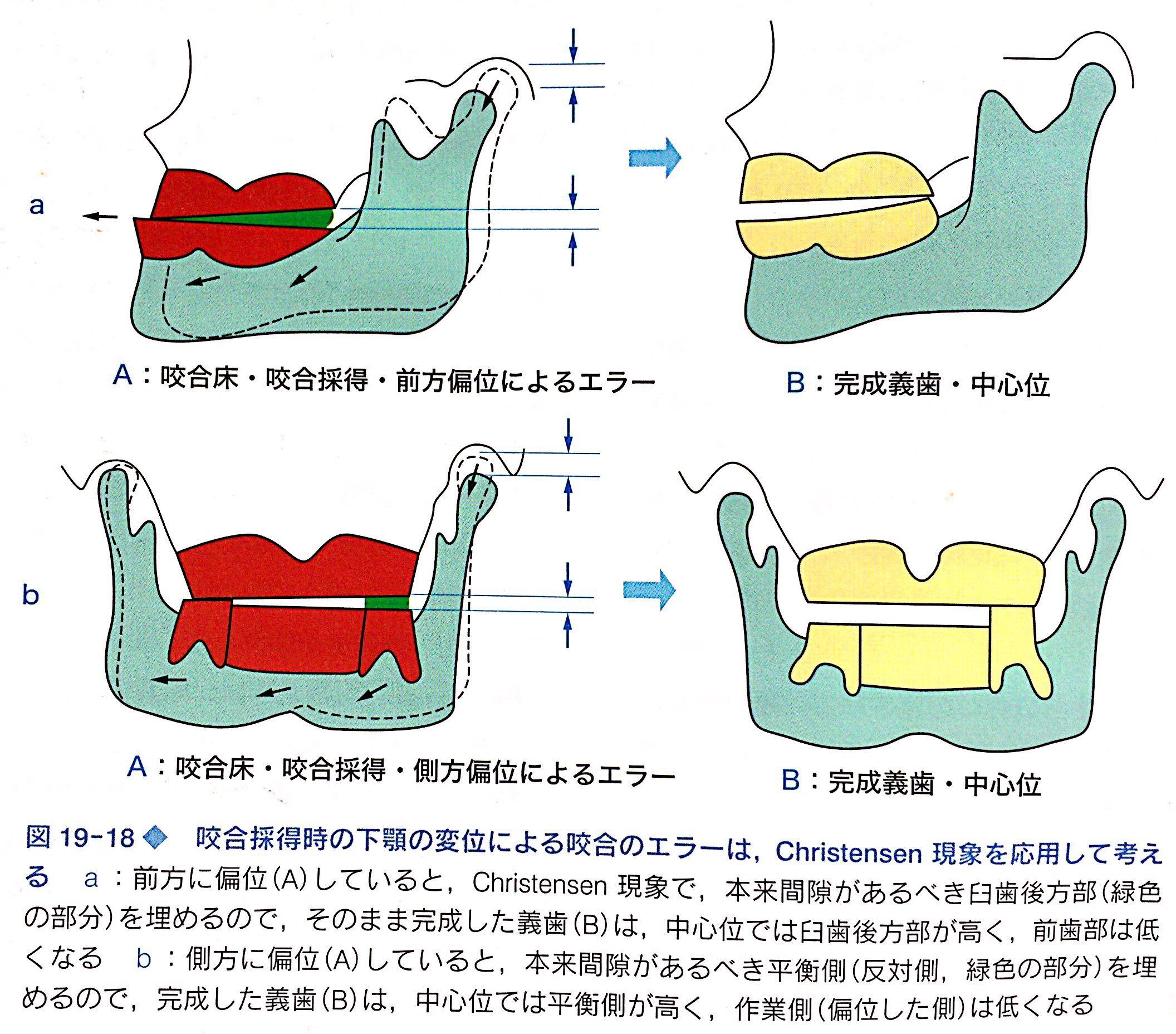 全部床義歯（フルデンチャー）、部分床義歯（パーシャル
