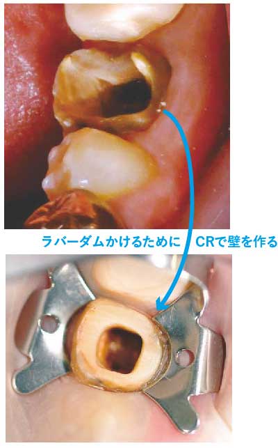 歯内療法のケ-スアセスメントと臨床 根管形態からみる